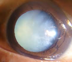 Mature Cataract