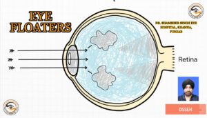Vitreous Floaters